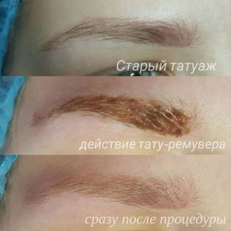 Удаление бровей ремувером crc Удаление бровей ремувером crc