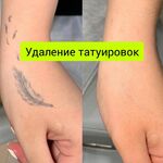 Сергей:  Удаление татуажа, татуировок.