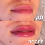 Анжела:  Увеличение губ коррекция асимметрии губ