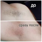 Валентина:  Электроэпиляция мск