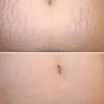 Антон:  Удаление растяжек на теле