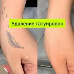 Сергей:  Удаление татуировок 