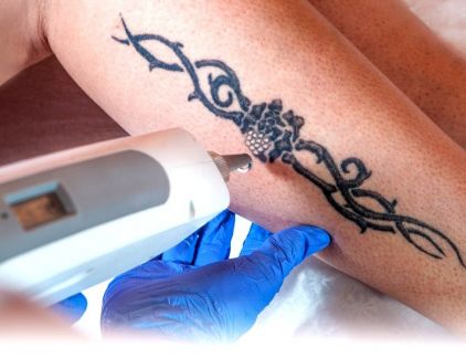 Удаление татуажа бровей в перми