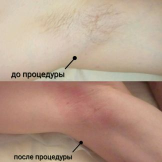 Спб удаление волос для мужчин