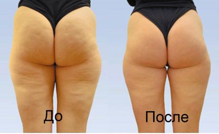 Казань массаж для похудения живота