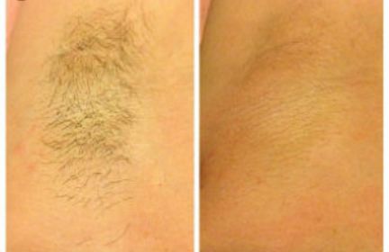 Удаление волос у мужчин в уфе
