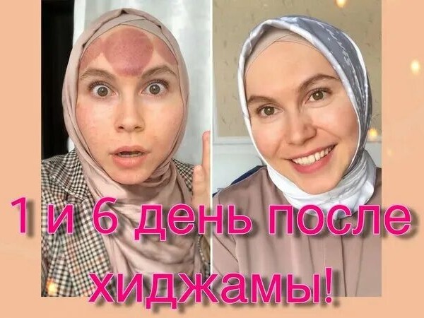 Хиджама Кровопускание Оздоровление по Сунне