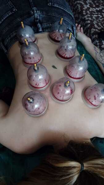 Баночная терапия(хиджама)