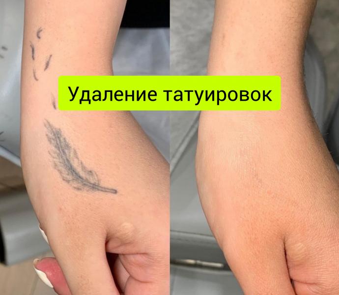 Сергей:  Удаление татуажа, татуировок.