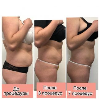 Resolady отзывы до и после Коррекция фигуры resolady