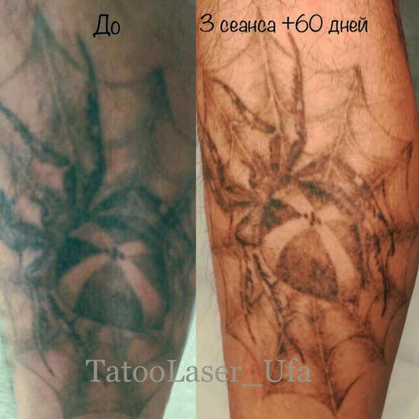 Руслан :  Удаление татуировок и татуажа.Карбоновый пилинг