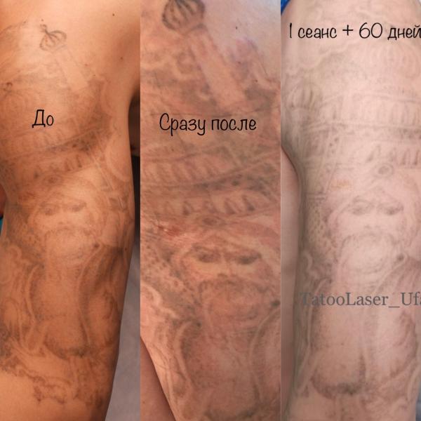 Руслан :  Удаление татуировок и татуажа.Карбоновый пилинг