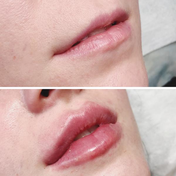 Анна:  Увеличение губ гиалуроновой кислотой 