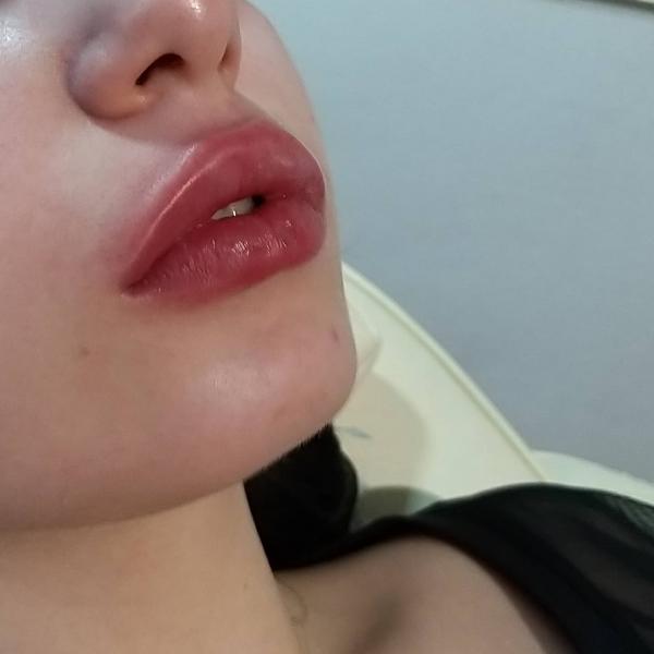 Юлия:  Увеличение губ гиалуроновой кислотой